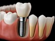 © typepng - The structure of healthy teeth and dental implants in the human denture is complex
