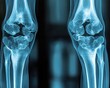© AFFANYUDA - X-ray image of two knees.  Detailed view of the knee joint structures, showcasing bone anatomy.  Possible medical diagnosis aid