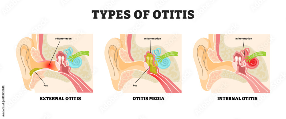 Vector de Stock Different types of otitis types, educational medical ...