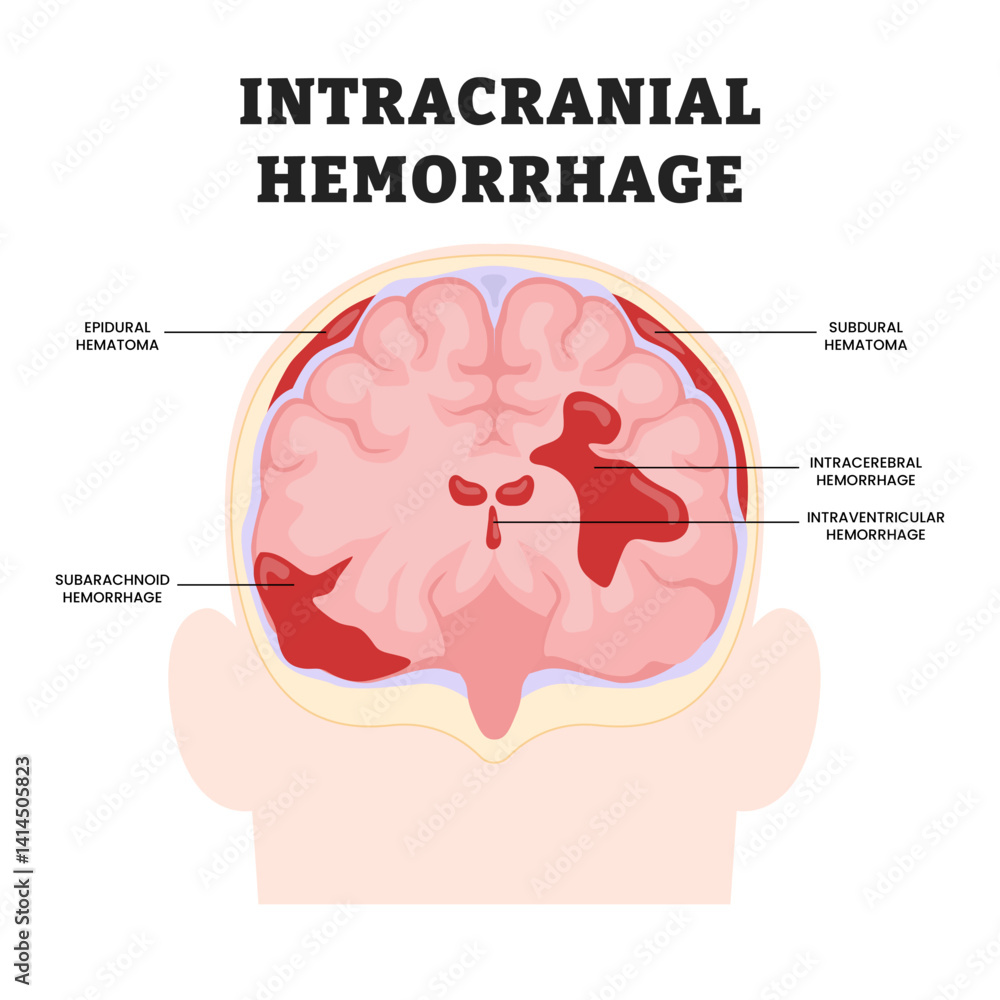 Set of various Intracranial Hemorrhage types, educational medical ...