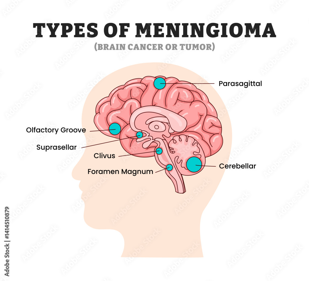 Different types of meningioma types, educational medical poster design ...