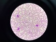 © toeytoey - This image shows a blood smear under a microscope, revealing an abnormally high number of platelets. The platelets appear as small, irregularly shaped cell fragments scattered throughout the field.