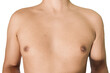 © roy - Cystic and hormonal acne on the chest of a man with a white background