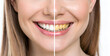© Aamir - Teeth Whitening Before and After Comparison Smile Transformation