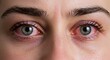 © phj.domingos - Close-up of red, irritated eyes with details of the iris and eyelashes, showing discomfort.