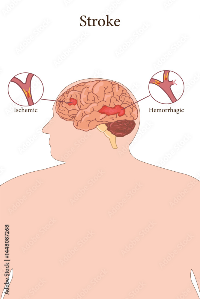 Medical illustration showing ischemic and hemorrhagic stroke in obese ...
