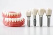 © Anat art - Comparison of Dental Solutions With Bridge, Denture, and Implant Displayed on a White Background for Patient Education Generative AI