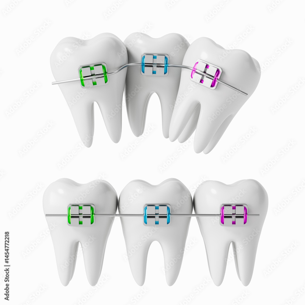 3D rendering of human teeth with colorful orthodontic braces showing ...
