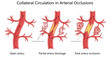 © Oleksandr Pokusai - blood flow changes in artery from open flow to partial blockage and total occlusion, highlighting collateral circulation diagram hand drawn schematic raster illustration. Medical science educational