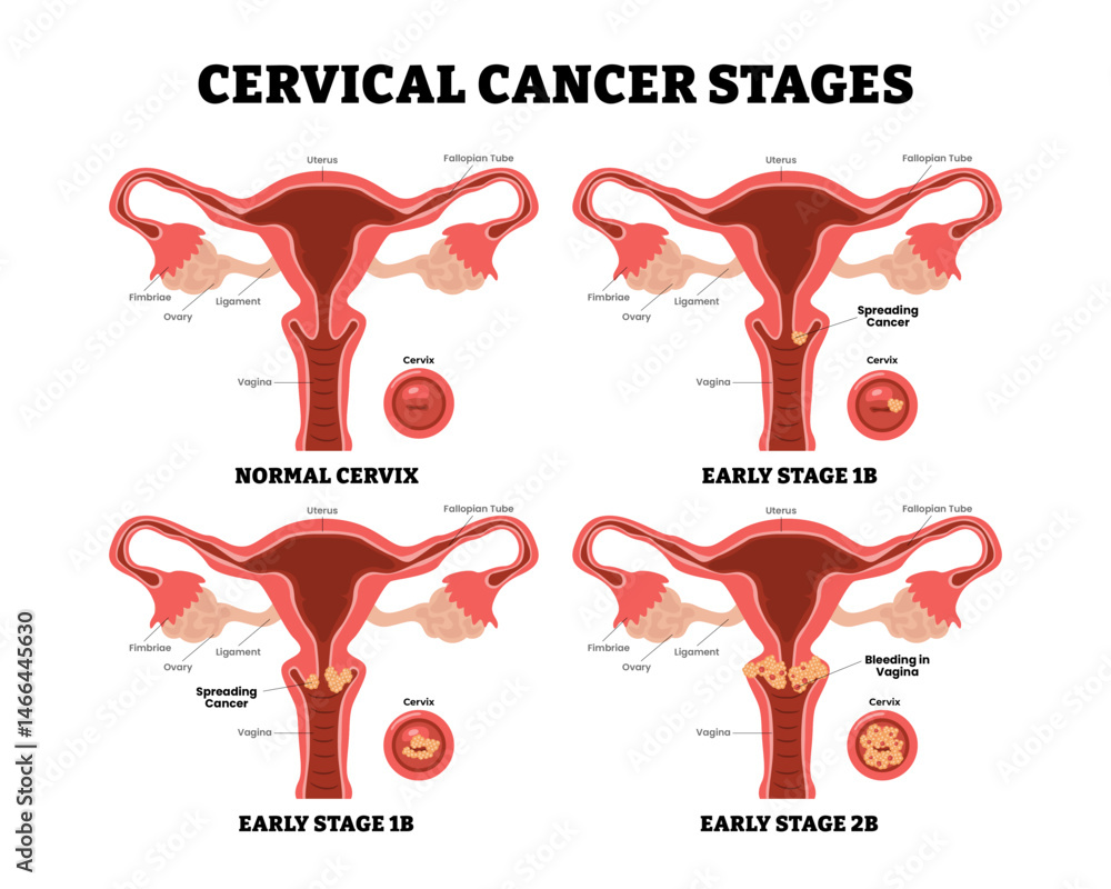 Cervical cancer stages process early stages progress, female ...