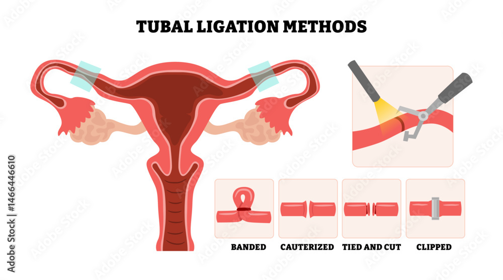 Tubal Ligation Methods banded, cauterized, clipped, tied and cut ...