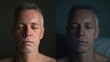© Antonio  - Myasthenia Gravis Awareness Month. Image showing the same person in the morning with normal muscle strength versus evening with facial muscle weakness from Myasthenia Gravis fatigue