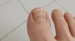 © Whisnu - Realistic close-up of a fungal nail infection, emphasizing the brittleness, thickening, and uneven surface of the toenail, with a clean ceramic floor as a background.