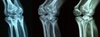 © AI04 - The humerus bone in the upper arm and the radius and ulna bones in the forearm are visible in this X-ray series of the human elbow joint