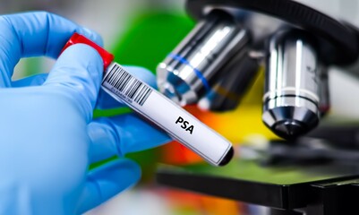 Blood sample tube for prostate specific antigen (PSA) test analysis.