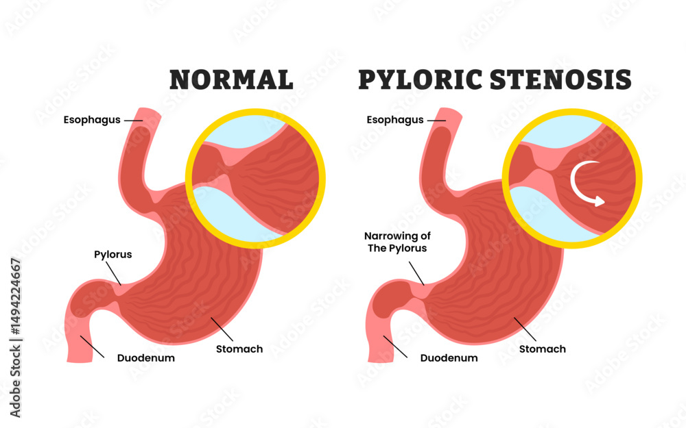 Normal VS Pyloric Stenosis Stomach Disease Educational Medical Poster 