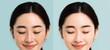 © typepng - Image of a young Asian woman's face showing the effects of melasma pigmentation treatment, highlighting skincare and health concerns through a before and after comparison
