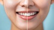 © Sobah - Comparison of teeth whitening before and after treatment.