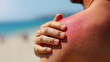 © Kateryna - Close-up view of sunburned shoulder with hand gently touching skin, showcasing the impact of hot weather on skin health