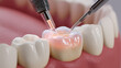 © Kevin - Dental Cavity Filling with Light Cure Process