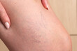© Vikto - Detailed view of spider veins on female skin. Medical condition of varicose capillaries often found on legs. Used in dermatology, health and wellness content.