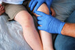 © Marina Demidiuk - Doctor examining child with bodily red rash. Kid allergy closeup. Little baby scratches an eruption. Nurse applies special cream to atopic skin. Dermatitis, irritation, hive. Pruritus. Mosquito bites