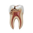 © SABBIR - 3D realistic decayed tooth with exposed pulp, cavity, and detailed internal anatomy on transparent background