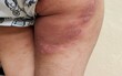 © Rung Kh - Portrait the rash hives allergy and inflammation skin, reaction and urticaria, infection and itchy, sensitive and symptom, scar and atopic on the legs of the woman, health care and medical concept.