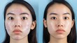 © Aynur - Before-and-after photos show an Asian woman's acne treatment.  The images illustrate skincare improvement and highlight beauty solutions for problematic skin.