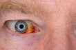 © Fotoforce - Damaged vein in the eye. Blood in the human eye. Closeup made with flash light.