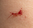 © studybos - A small red mark on a person's arm