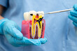 © kanruthai - Teeth root dental model with tool for dentist use to cleaning care treatment.