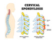 © vesvocrea - Cervical Spondylosis, Spine Structure Anatomy, Spinal Disease Educational Medical Poster Design Healthcare Scheme, Labeled Disc Degeneration, Bulging Disk, Bone Spurs, Arthritis, Inflammation Vertebra