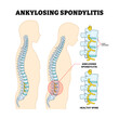 © vesvocrea - Ankylosing Spondylitis or Bamboo Spine Spinal Disease, Educational Medical Poster Design Healthcare Scheme, Labeled Fused Vertebrae, Human Chronic Inflammation Backbone Structure Anatomy.