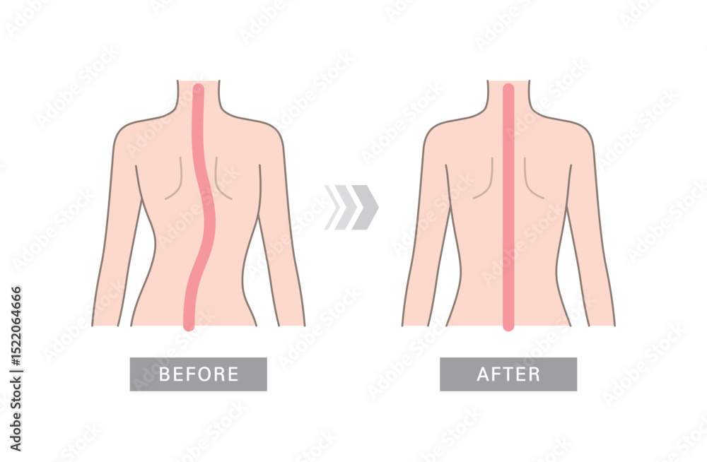 Curved human spine and back. Illustration of scoliosis, normal spine ...