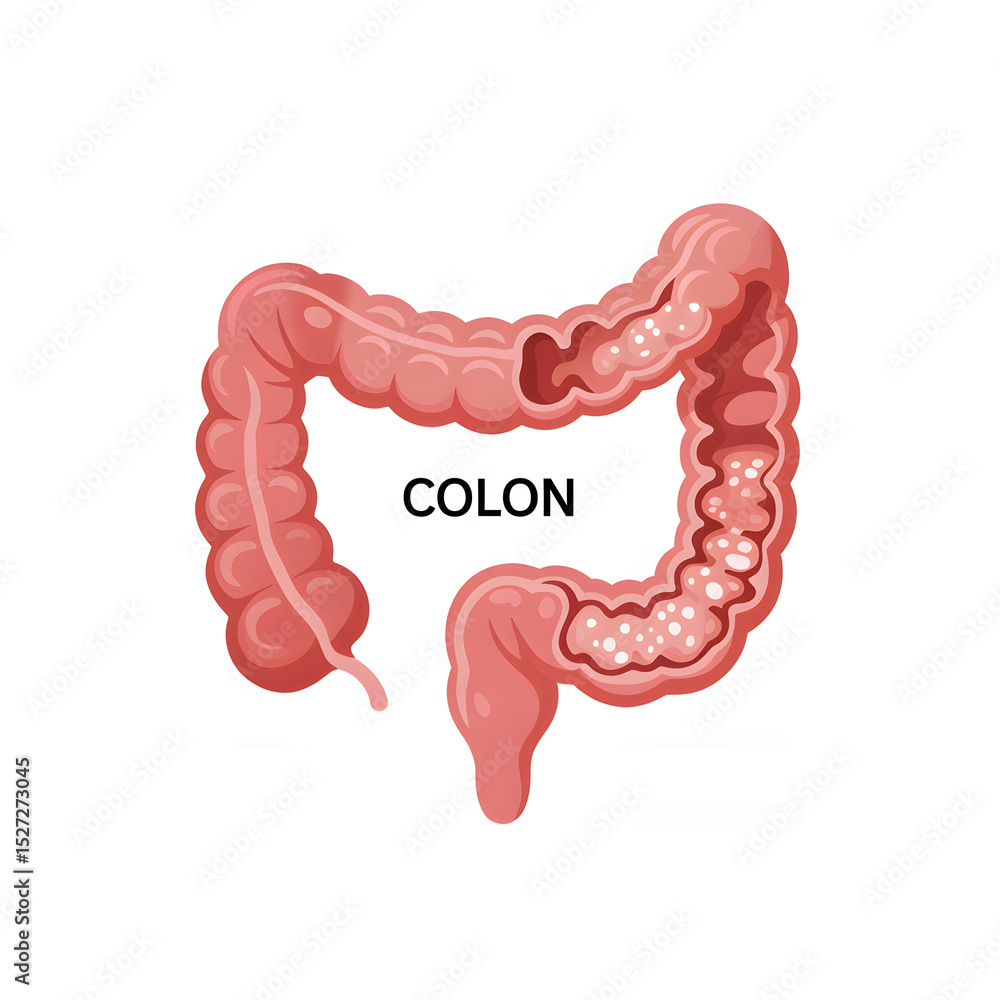 Nice Normal Colon Medical illustration showing healthy colon compared to colon cancer ...