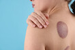 © New Africa - Woman after cupping therapy on light blue background, closeup. Space for text