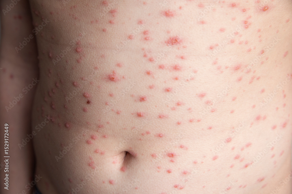 Chickenpox Rash On The Boy s Body The Child Has Chickenpox Red Spots Chickenpox Rash On The Boy s Body The Child Has Chickenpox Red Spots
