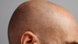© frank - Extreme close-up of human scalp showing symptoms of alopecia areata, symbolizing hair loss disorder and the need for medical or cosmetic intervention