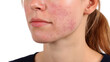 © Justlight - Close up of a woman's face with visible rash symptoms, potentially indicating a skin condition like lupus, isolated on a transparent background for easy integration into various projects