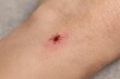 © Space Priest - Close-up of red tick on human skin causing irritation and potential health risk
