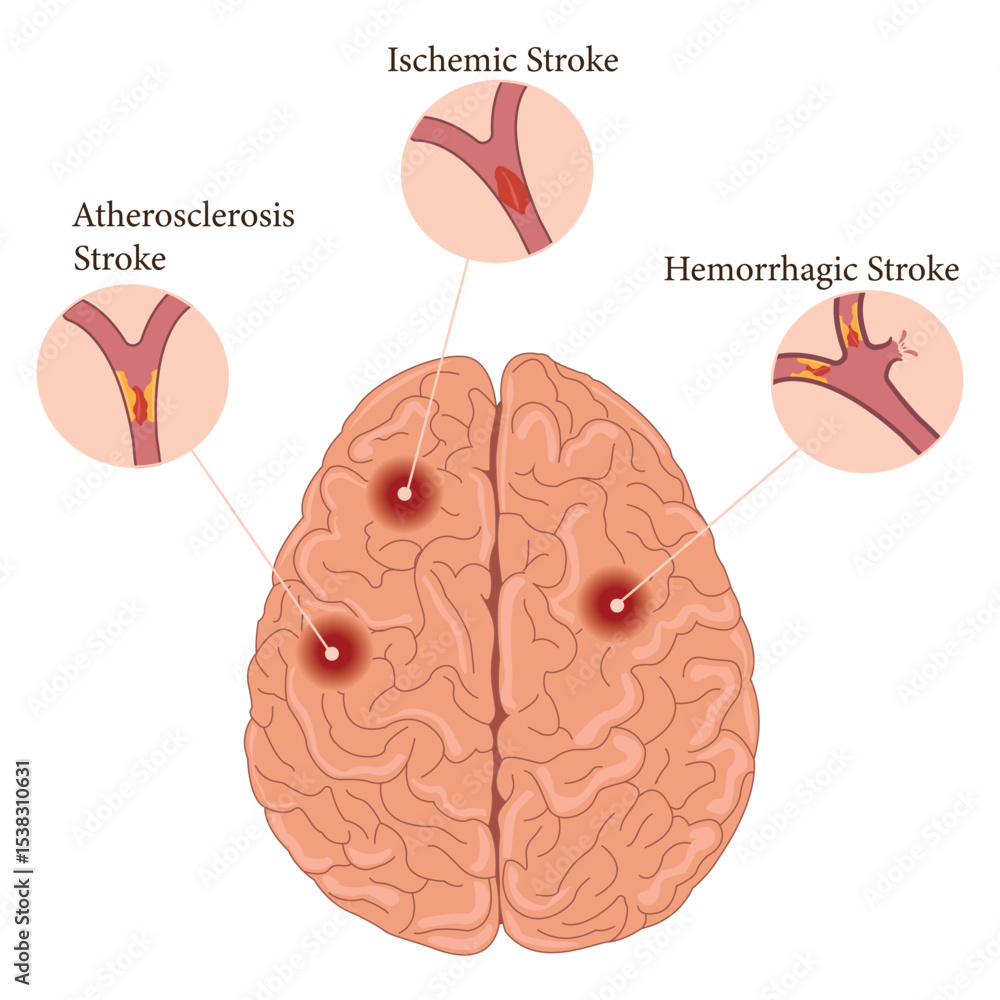 Brain stroke types infographic: ischemic, hemorrhagic, and ...