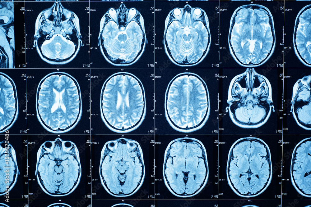 Closeup of a CT scan with brain. Medical, science and education mri ...
