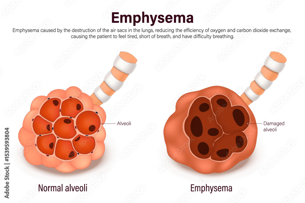 Emphysema Comparison Between Normal Alveoli And Emphysema Lung Emphysema Comparison Between Normal Alveoli And Emphysema Lung