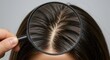 © Dear.Yun - Scalp pores enlarged with a magnifying glass. Hair loss, scalp care concept.