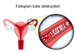 © designua - Fallopian tube obstruction. Female infertility