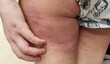 © Rung Kh - Portrait the rash hives allergy and inflammation skin, reaction and urticaria, infection and itchy, sensitive and symptom, scar and atopic on the legs of the woman, health care and medical concept.