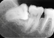 © therads - Periapical x-ray showing malposition of right lower wisdom tooth and caries on a second mandibular molar.