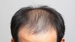 © AI-HAL8 - 前頭部の薄毛が目立つ男性の頭部アップ｜抜け毛,加齢,ヘアケア