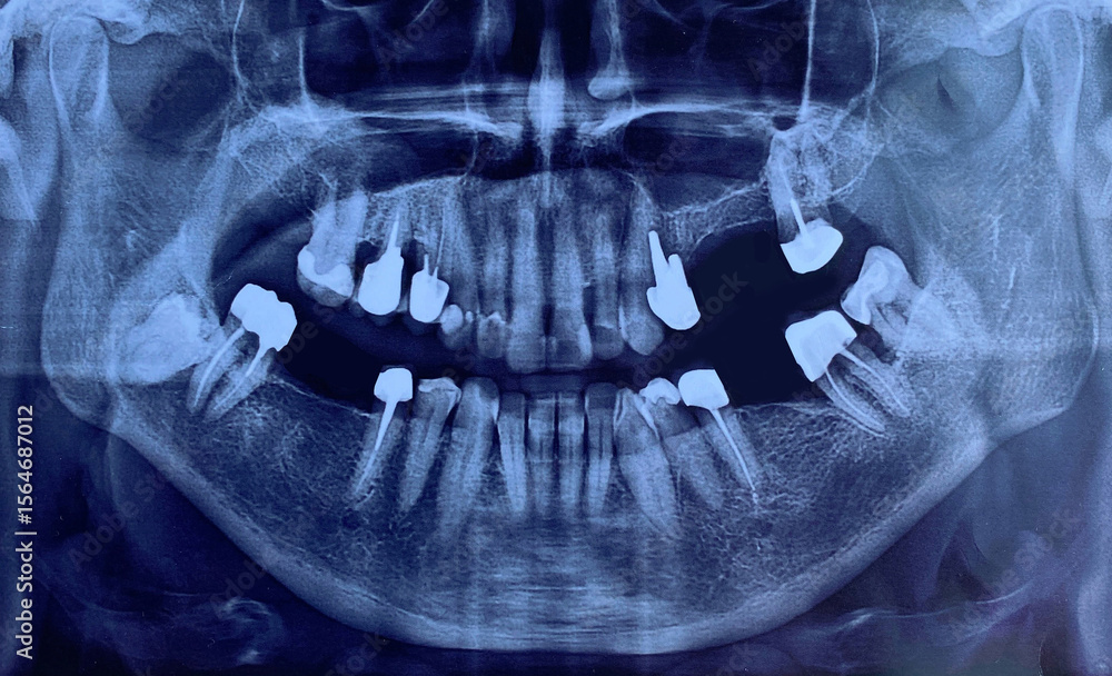 Close-up of image panoramic x-ray of teeth and jaw human Stock Photo ...